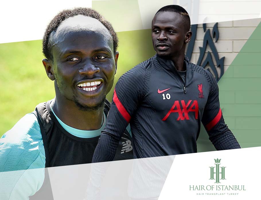 Sadio Mane Hair Transplant From Hairline To Forehead Victory