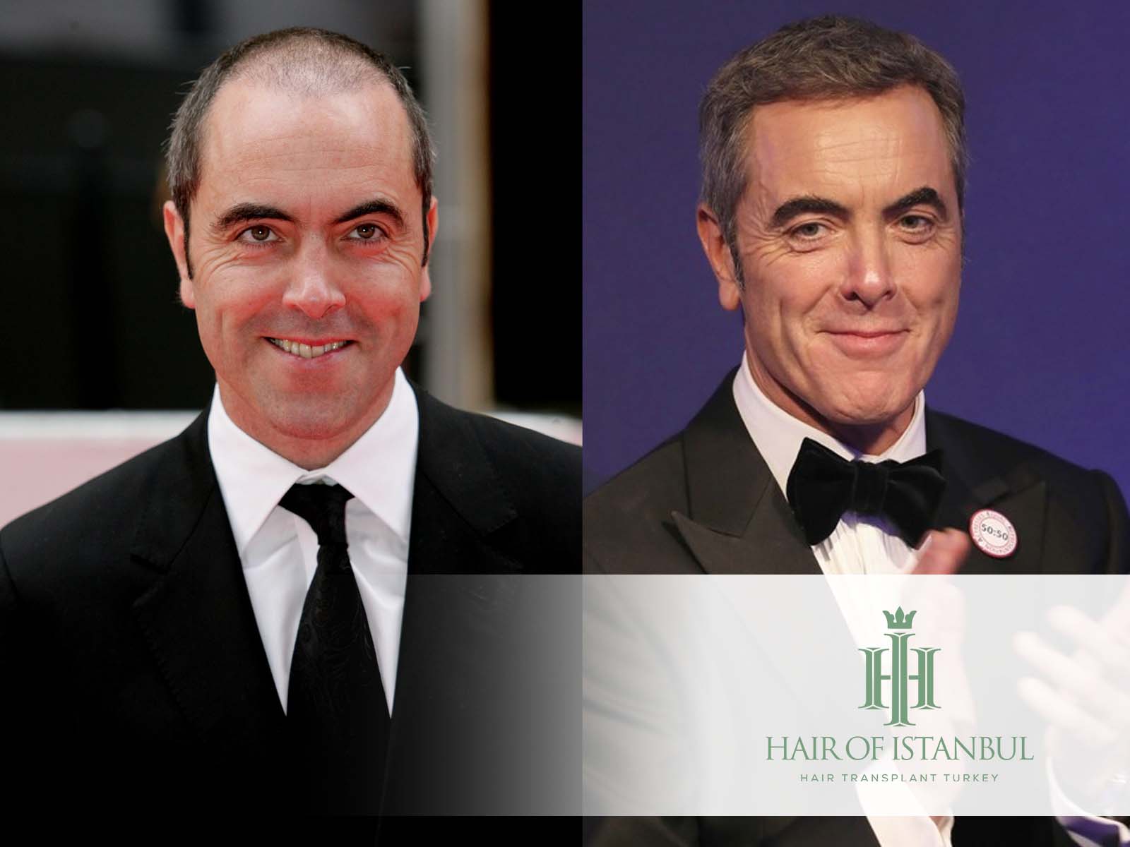 James Nesbitt Hair Transplant The Real Story Of Transformation Hair