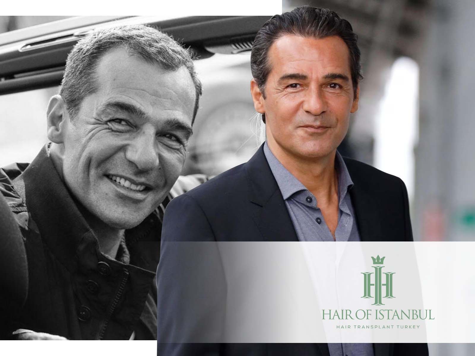 Erol Sander Und Das R Tsel Seiner Dichten Haare Haartransplantation