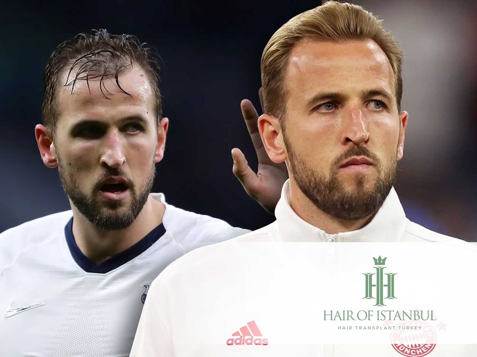 Harry Kane Hair Transplant A Striker S New Look