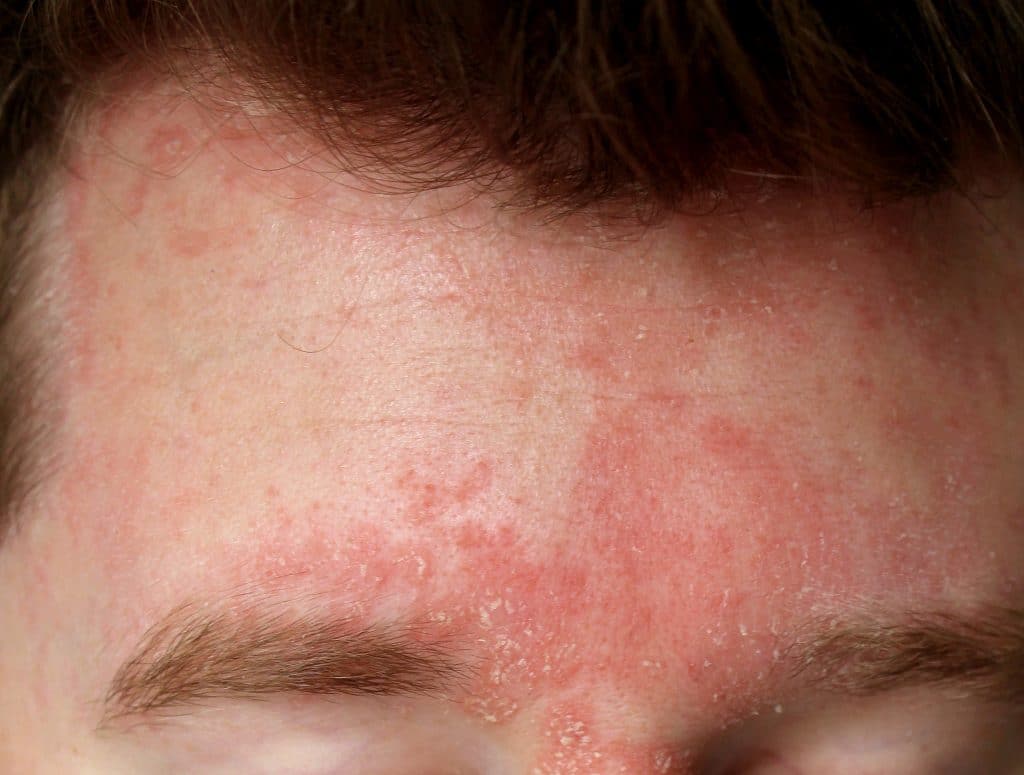 Importance Of Seborrheic Dermatitis On Hair Transplant