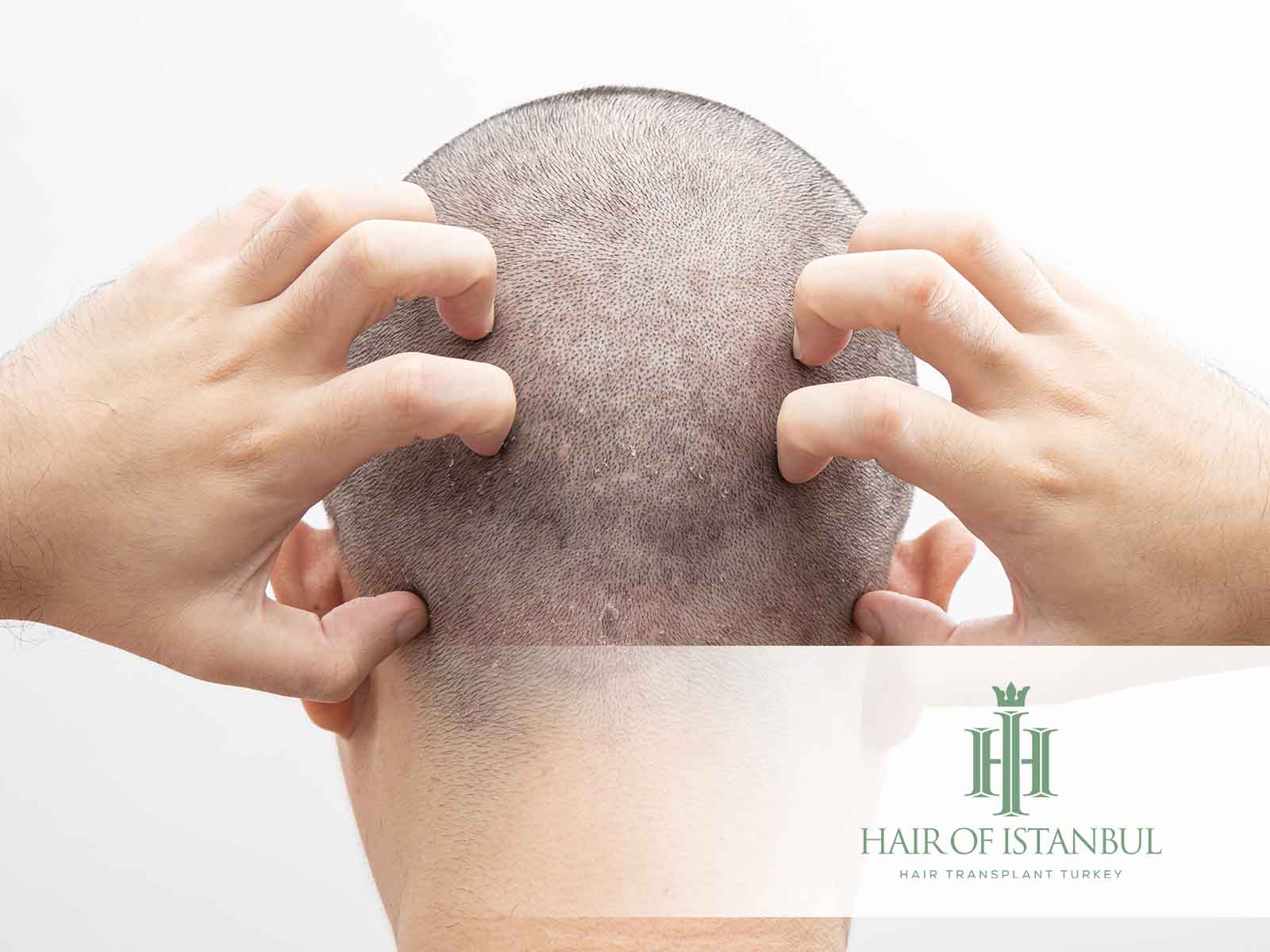 Importance Of Seborrheic Dermatitis On Hair Transplant