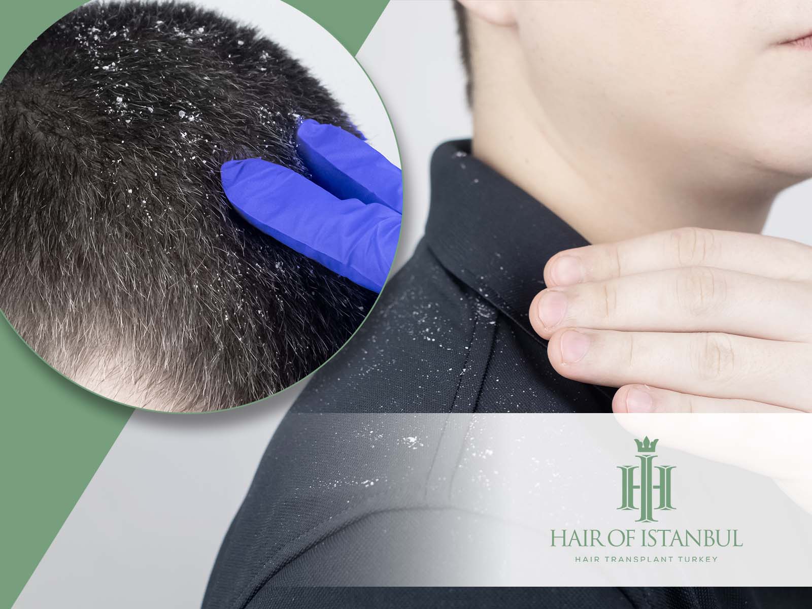 How To Grow Hair Back After A Scalp Fungal Infection 