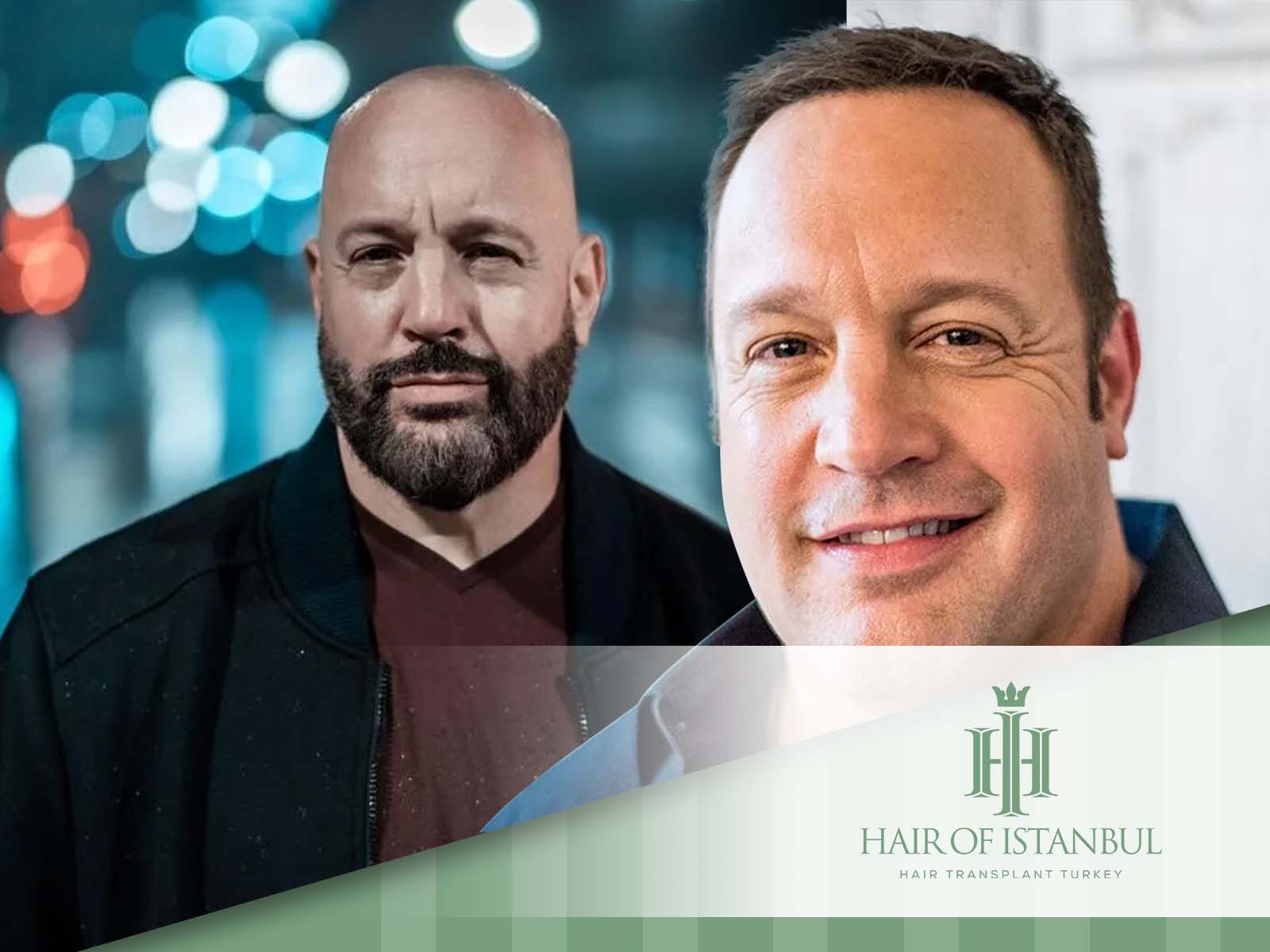 Is Kevin James New Look the Result of a Hair Transplant