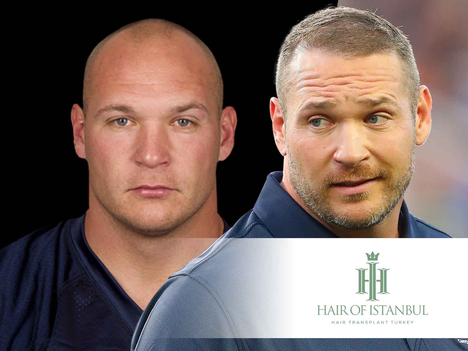 Brian Urlacher Hair Transplant Speculations Realities Explored