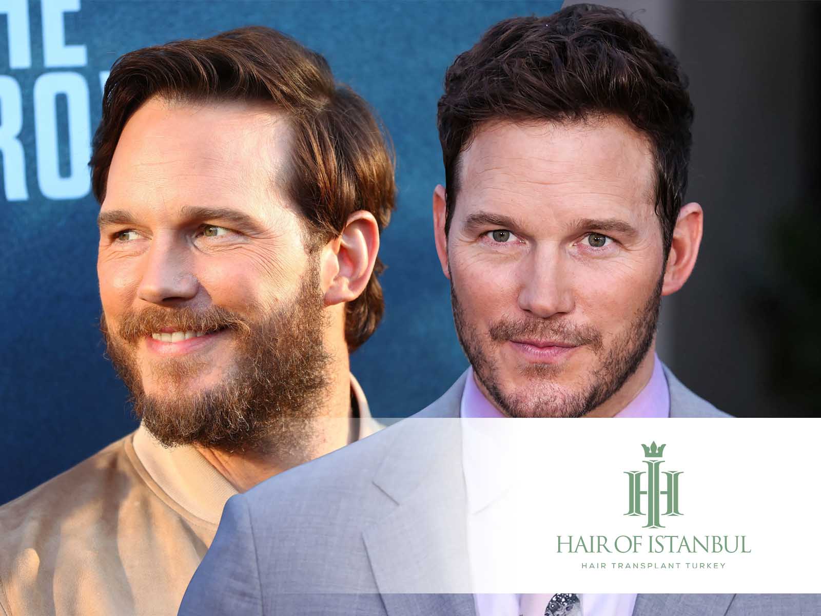 Chris Pratt Hair Transplant Delving Deep into the Procedure