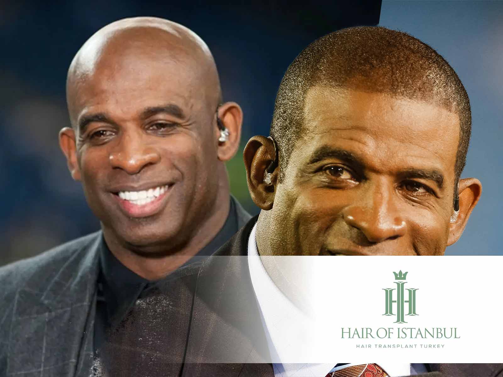 Deion Sanders Hair Transplant A Comeback Off the Field