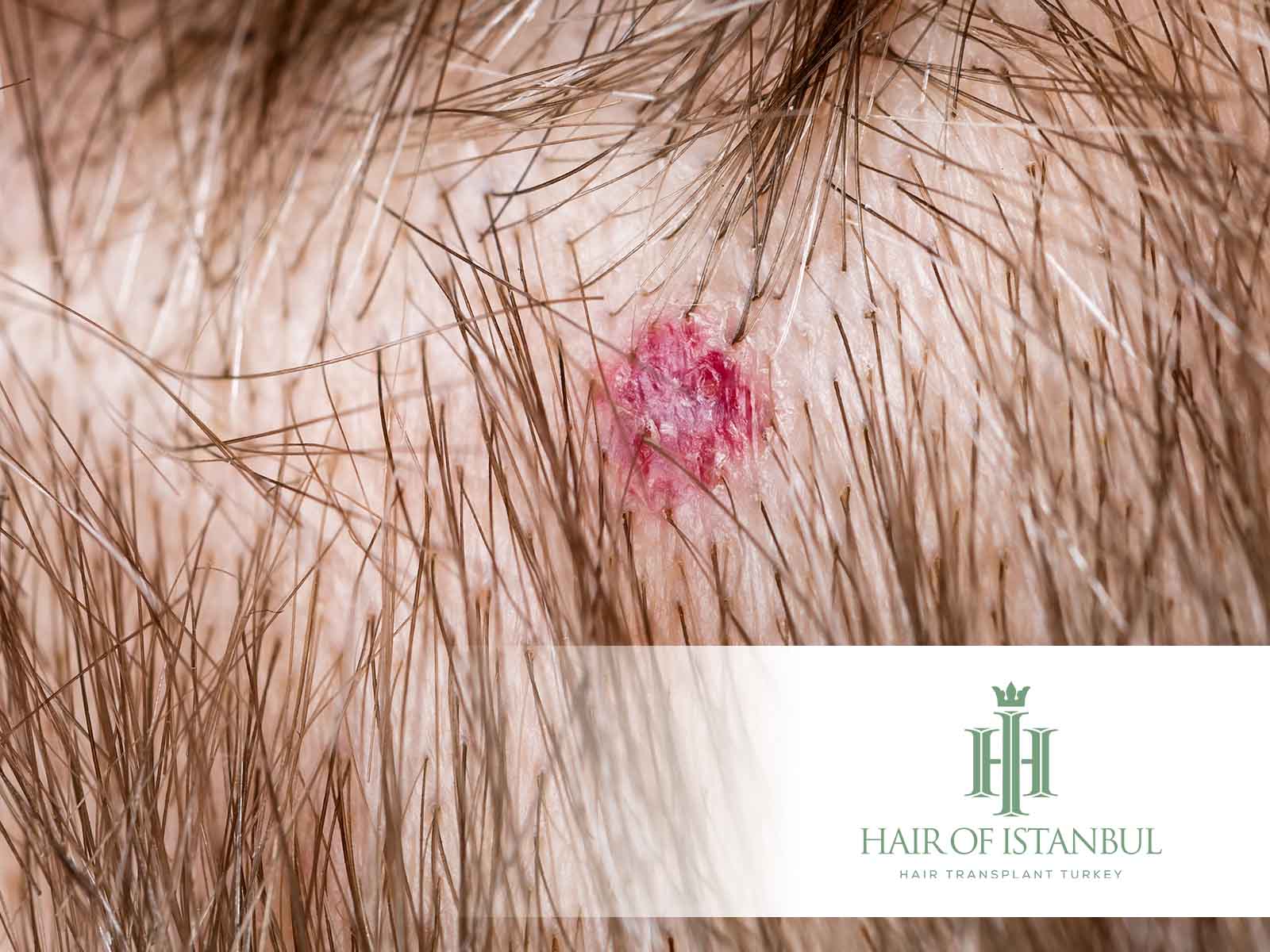 Folliculitis After Hair Transplant: Symptoms, Causes, Treatments