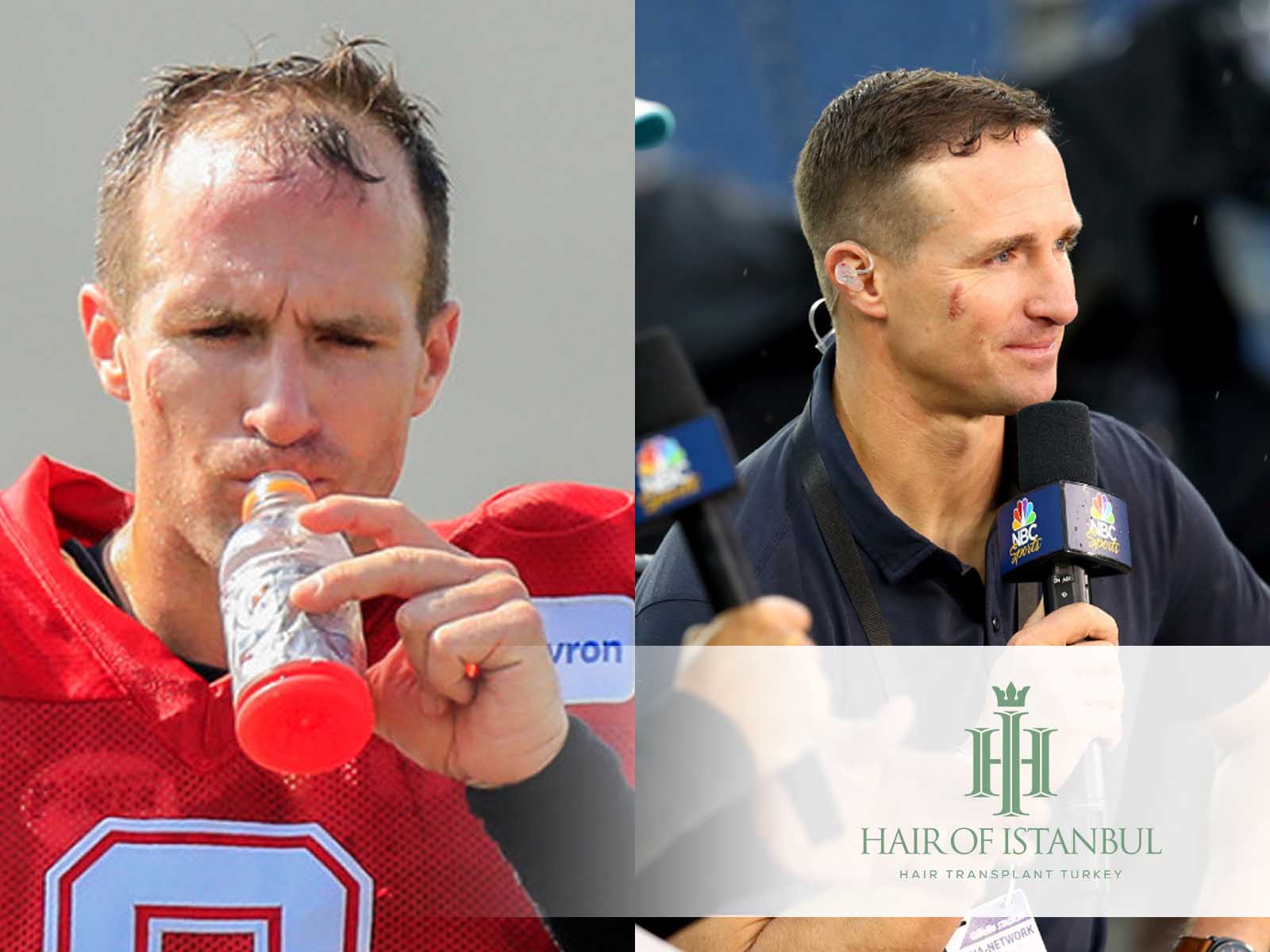 Drew Brees Hair Transplant: A Look Beyond The Helmet!