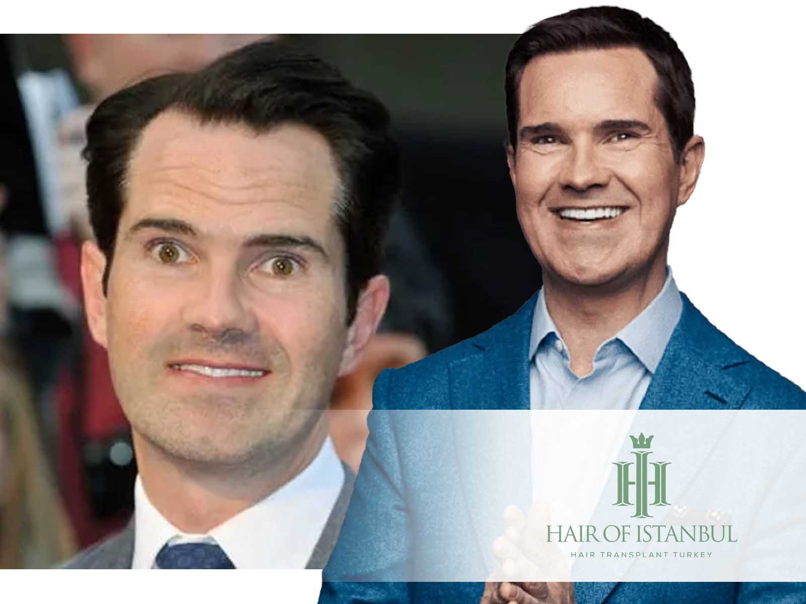 Jimmy Carr Hair Transplant: Transformation Secrets Revealed