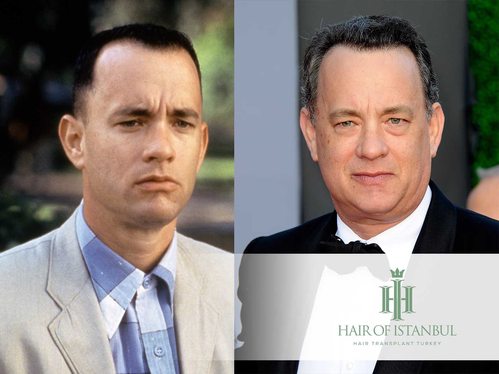 Tom Hanks Hair Transplant: The Truth Behind the Rumors