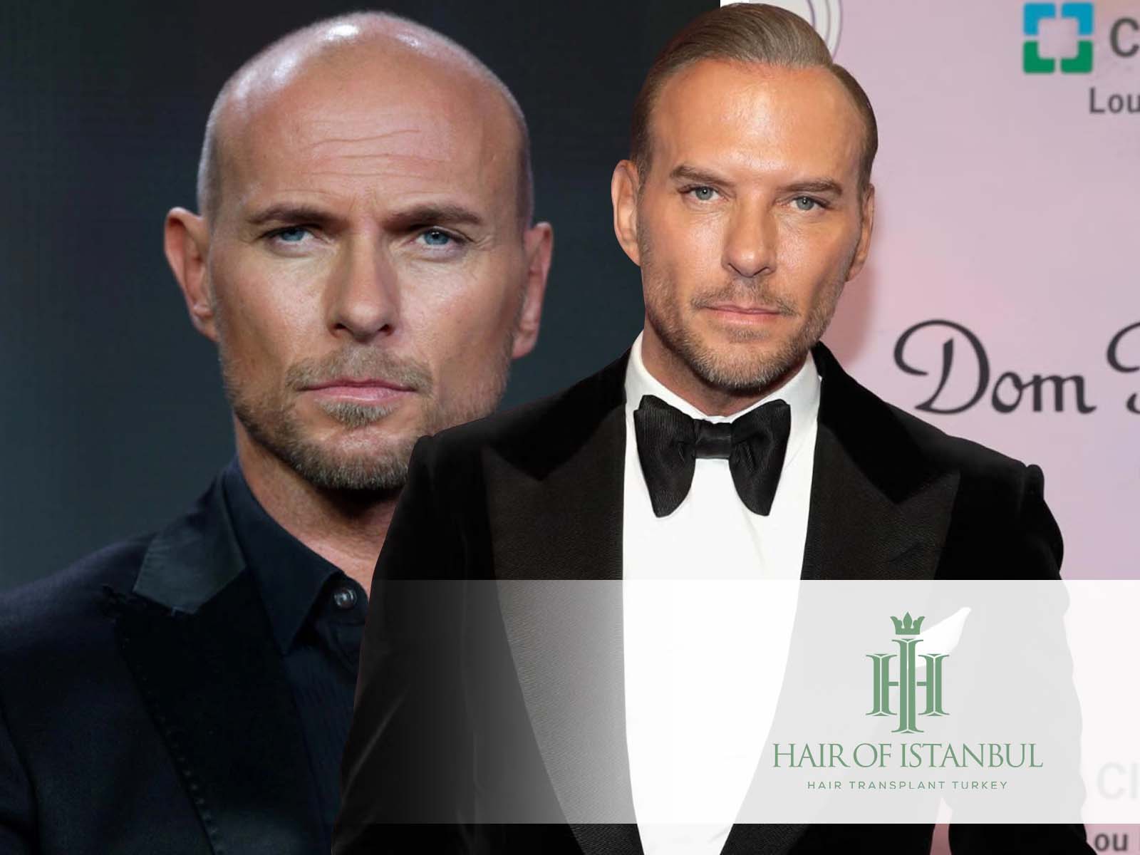 Matt Goss Hair Transplant From Gossip to Facts