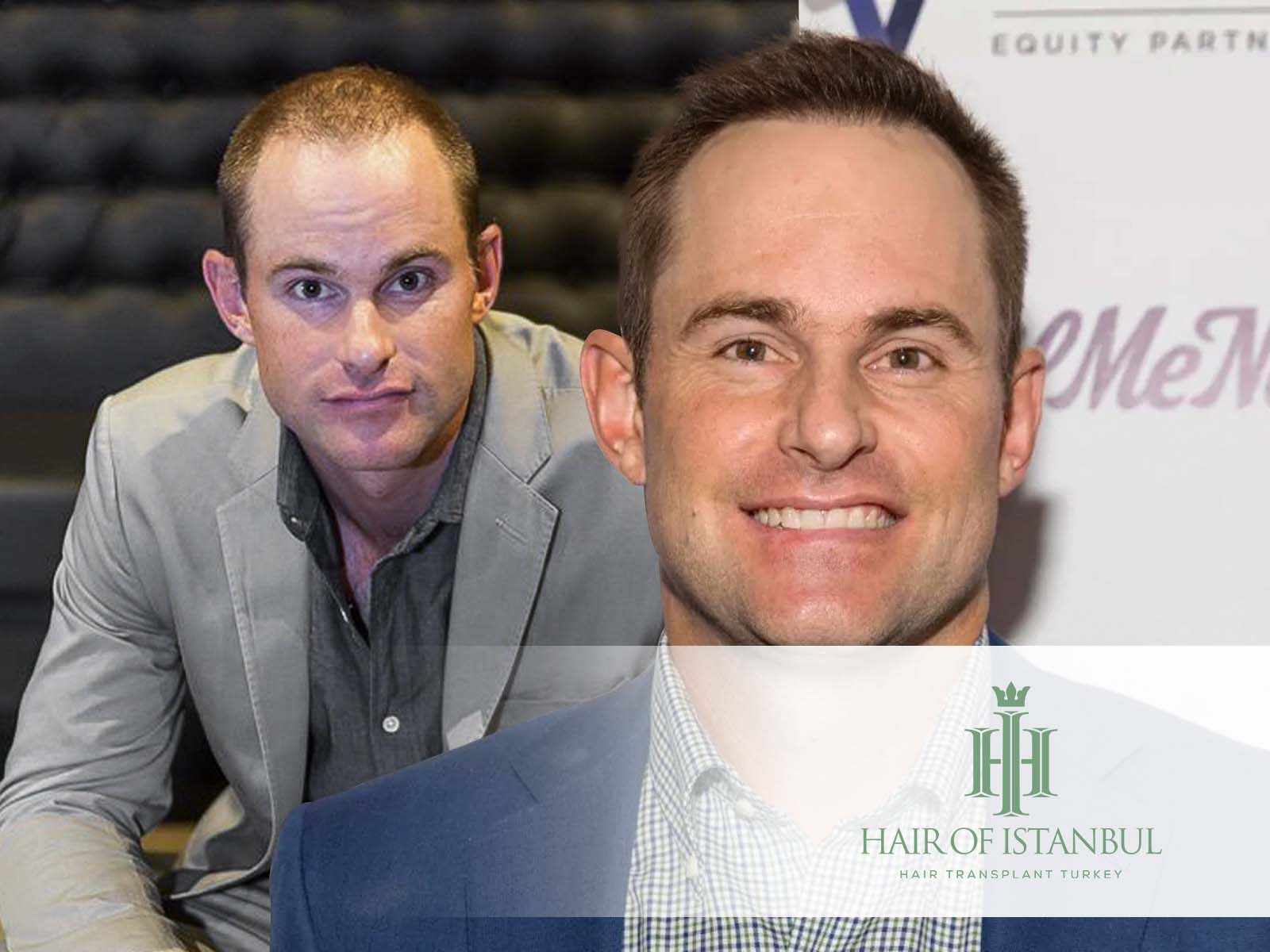 Andy Roddick Hair Transplant: From Baseline To Hairline