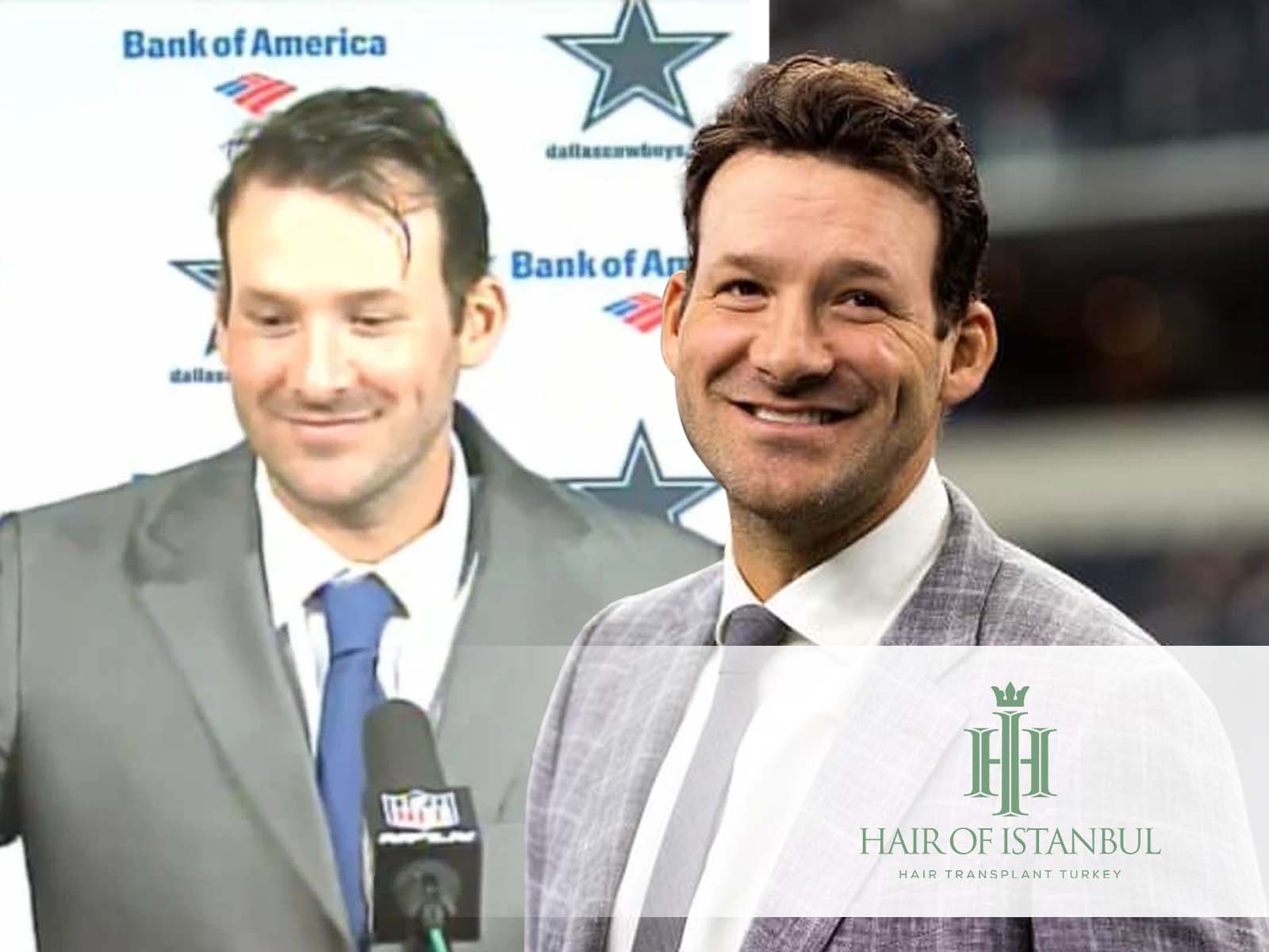 Tony Romo Hair Transplant The Secret Behind His Helmet