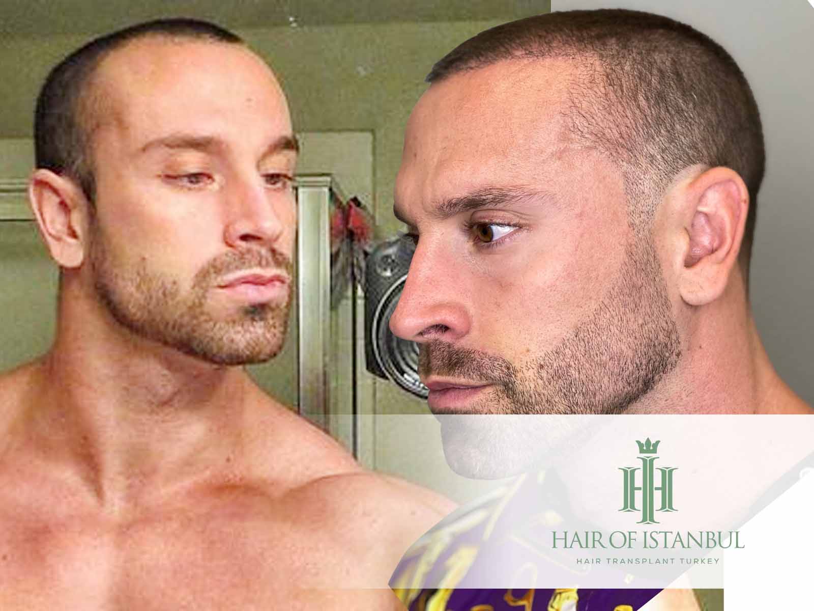 Bradley Martyn Hair Transplant: A Closer Look at the Facts!