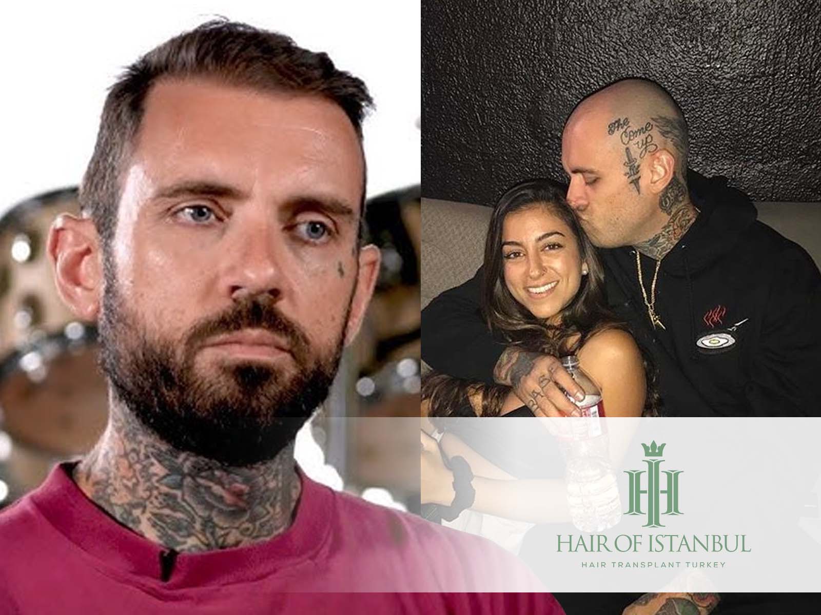 Adam22 Hair Transplant: Fact or Fiction The Ultimate Reveal!