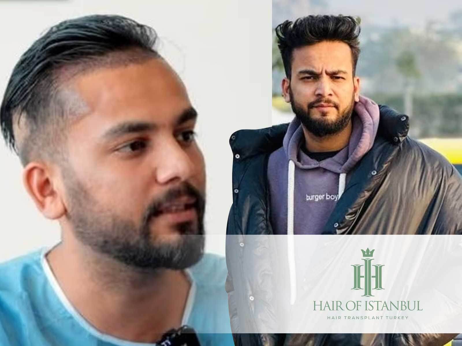 Elvish Yadav Hair Transplant