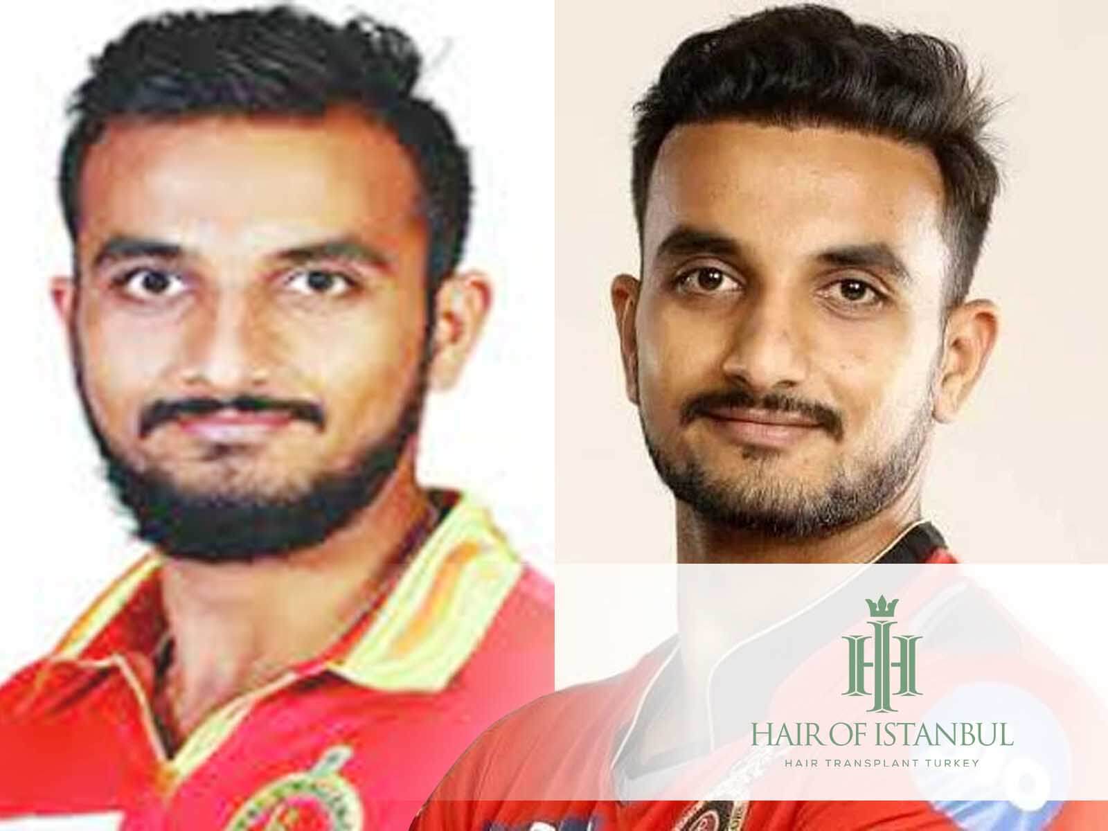 Harshal Patel Hair Transplant