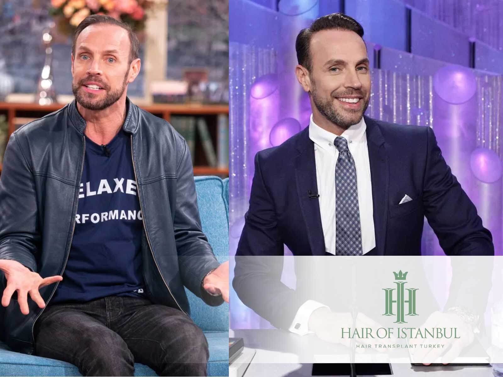 Jason Gardiner Hair Transplant