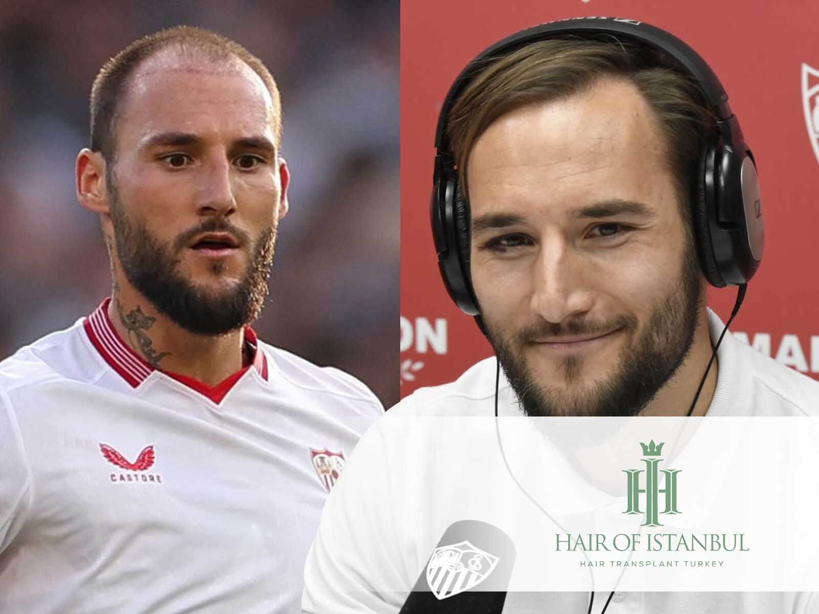 Nemanja Gudelj Hair Transplant